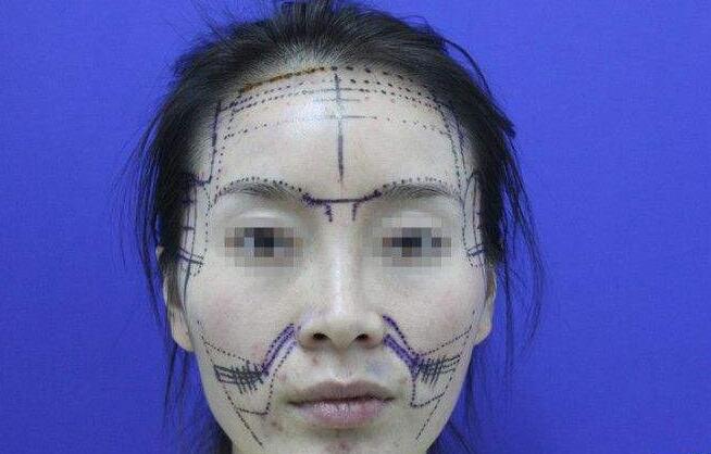 鼻唇溝填充能維持多久？可以選擇哪些材料？