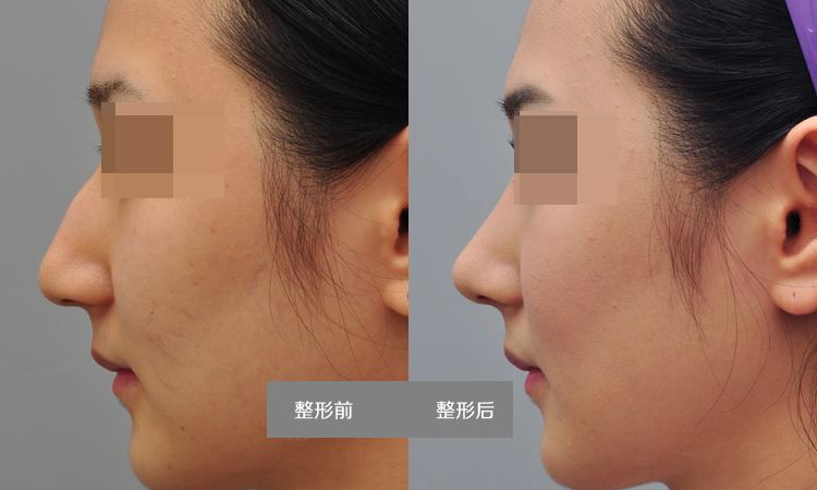 駝峰鼻矯正多少錢？駝峰鼻矯正術(shù)的幾種方法