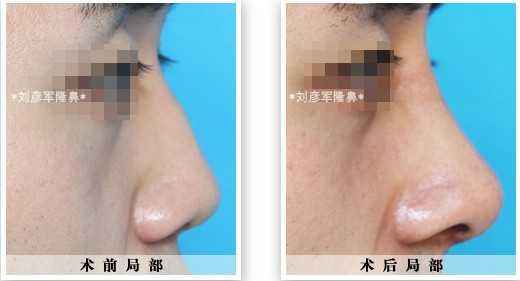 駝峰鼻矯正多少錢？駝峰鼻矯正術(shù)的幾種方法