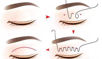 北京埋線雙眼皮修復(fù)哪些醫(yī)生技術(shù)好？