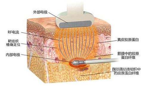 激光溶脂多少錢？聽說它創(chuàng)傷小、恢復(fù)快