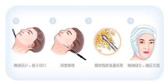 激光溶脂多少錢？聽說它創(chuàng)傷小、恢復(fù)快