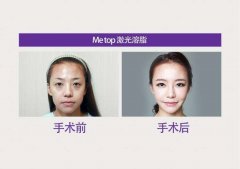 激光溶脂價(jià)格和果講解，原來可以做這些部位！