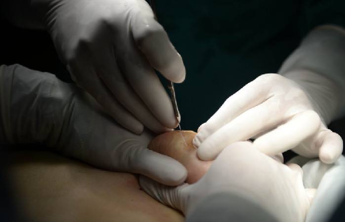 怕疼的人想問問沒多少痛感隆胸這種方法有沒有？