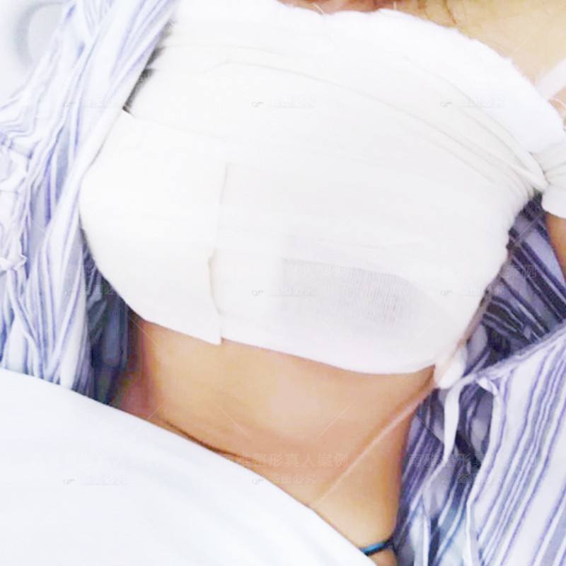 蜜桃假體隆胸自然嗎？會不會看著很假？