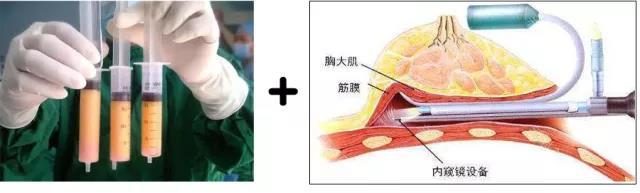 蜜桃假體隆胸自然嗎？會不會看著很假？