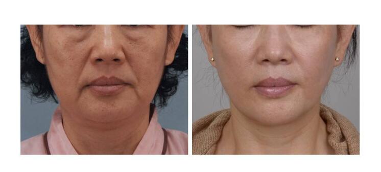 想知道北京面部提升多少錢？看一下詳細(xì)的數(shù)據(jù)