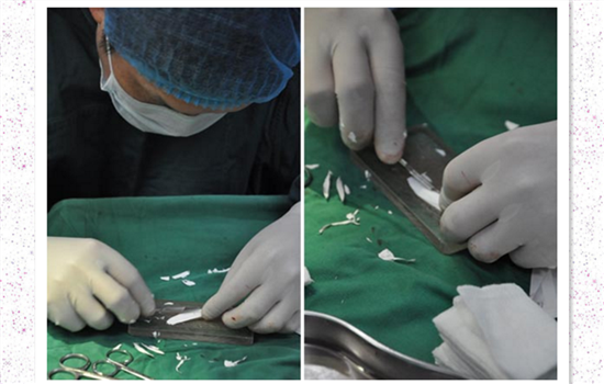 北京膨體隆鼻多少錢？聽說膨體容易感染是真的嗎？