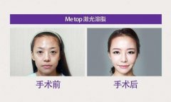 激光溶脂瘦大腿果怎么樣？會(huì)反彈嗎？