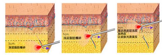 激光溶脂瘦大腿果怎么樣？會反彈嗎？