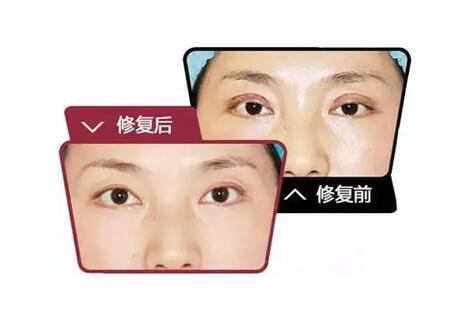 想知道雙眼皮修復(fù)前后能改良哪些問(wèn)題？主要有這些