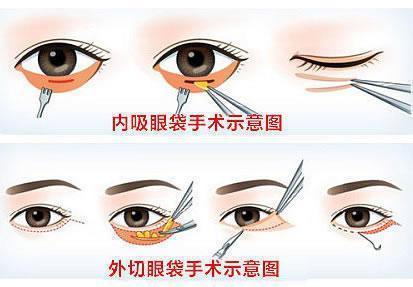 去眼袋手術(shù)圖片：不同的調(diào)節(jié)方式對(duì)應(yīng)解決的眼袋類型不一樣！