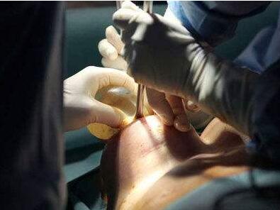 找劉旺醫(yī)生做隆胸手術(shù)，見證了“零出血”，還有微創(chuàng)隆胸等等