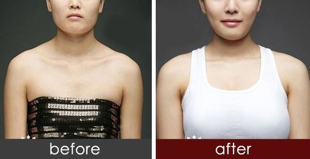 找劉醫(yī)生做隆胸手術(shù)，見證了“零出血”，還有微創(chuàng)隆胸等等