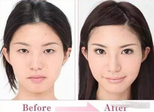 醫(yī)生隆鼻案例圖