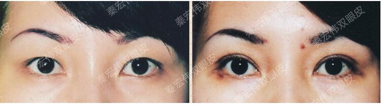 北京伊美爾紫竹醫(yī)院秦宏偉醫(yī)生雙眼皮案例圖