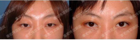 北京伊美爾紫竹醫(yī)院秦宏偉醫(yī)生雙眼皮案例圖