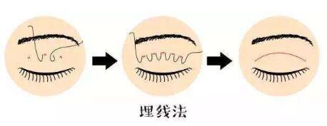 埋線法雙眼皮手術(shù)過程
