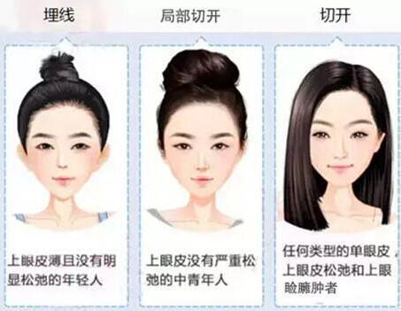 埋線雙眼皮手術(shù)的適應(yīng)人群