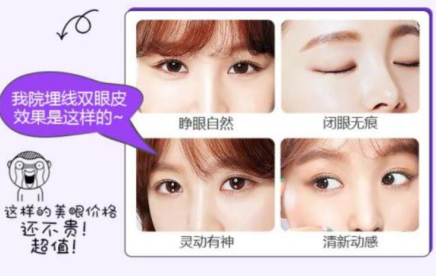 埋線雙眼皮真人案例圖