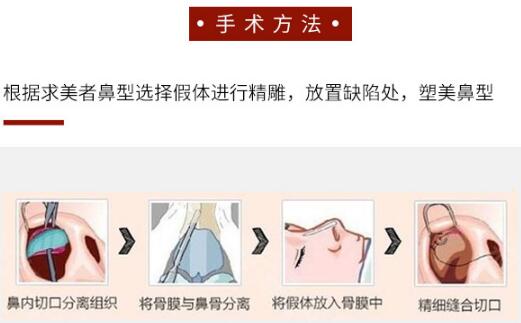 硅膠隆鼻要多少錢
