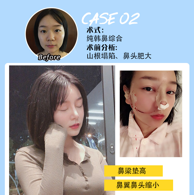 硅膠隆鼻要多少錢