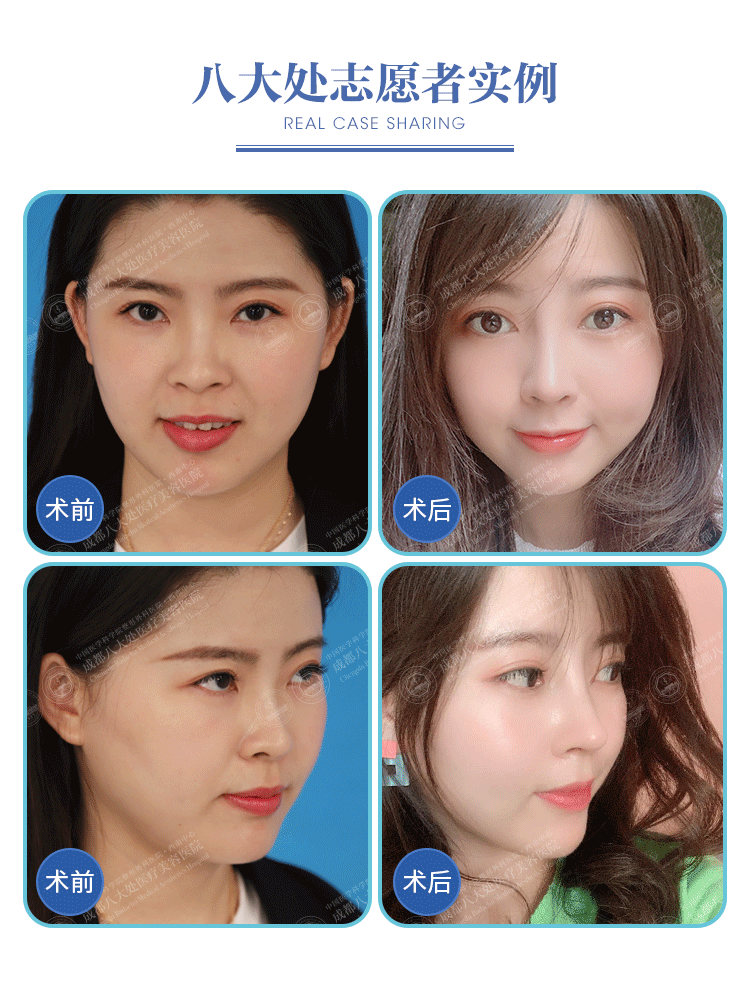 【揭秘】北京隆鼻價(jià)錢超貴？真相是……