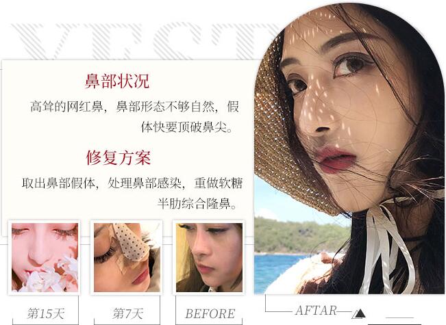 膨體隆鼻后取出假體，手術是這樣做的！