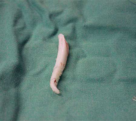 硅膠隆鼻整形術(shù)容易透光？這點(diǎn)你介意嗎