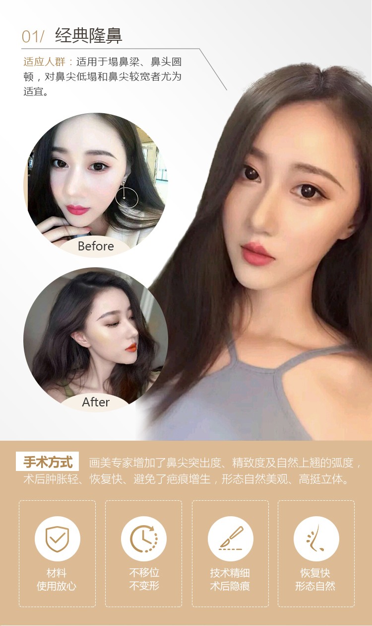 上海隆鼻哪里好 案例圖