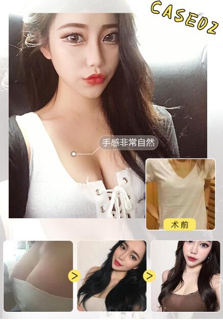 做了胸部乳房假體植入手術(shù)調(diào)節(jié)以后的護理指導