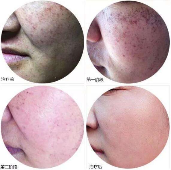 誰做過復合彩光嫩膚？做過以后擺脫數(shù)年的雀斑