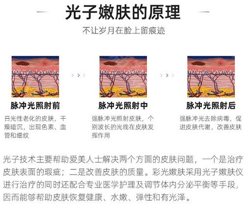 誰做過復合彩光嫩膚？做過以后擺脫數(shù)年的雀斑