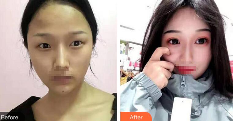 濟南芭莎美恩雙眼皮案例圖