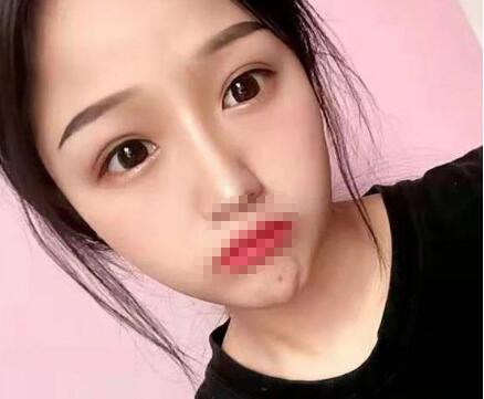 濟南芭莎美恩雙眼皮案例圖