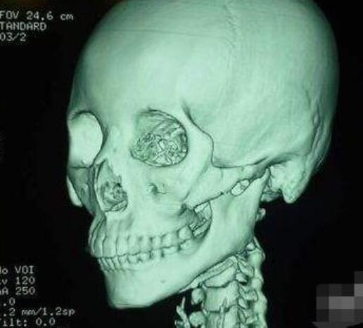 醫(yī)美達(dá)人告訴你下頜角磨骨術(shù)的危害