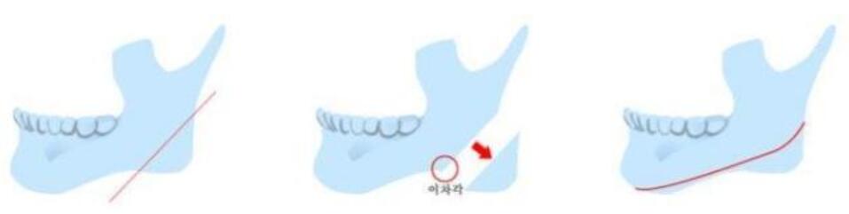 下磨頜角手術(shù)操作圖