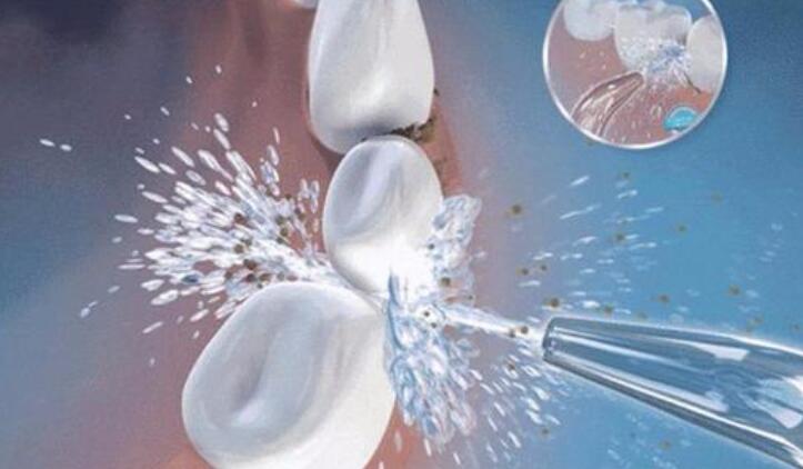 現(xiàn)在，洗牙的主要方法是超聲波清洗