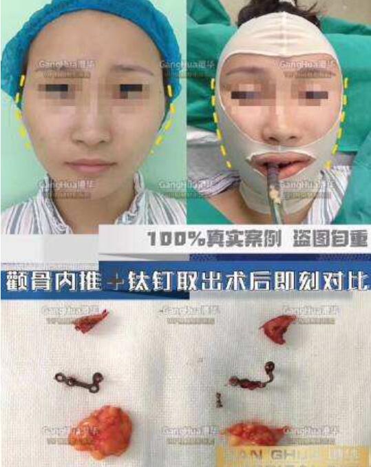 顴骨整形手術(shù)風(fēng)險和后遺癥