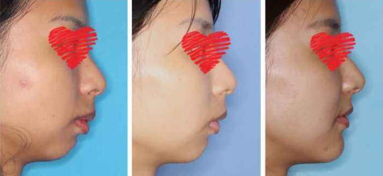 正頜手術(shù)前后照片