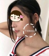上海首爾麗格下頜角手術(shù)案例，成功擁有“高級臉”！