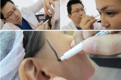 真實(shí)案例：下頜角截骨前后果對(duì)比果圖分享