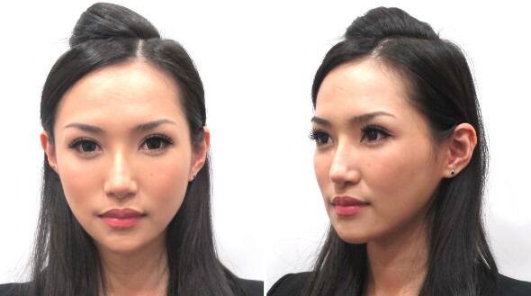 真實(shí)案例：下頜角截骨前后果對(duì)比果圖分享