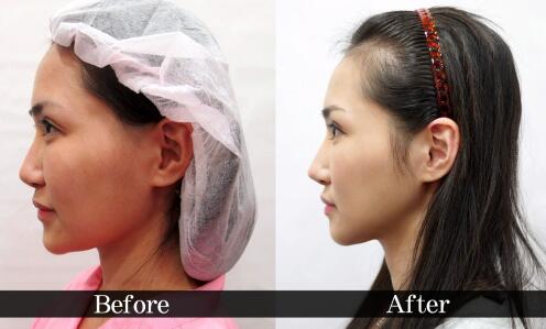 真實(shí)案例：下頜角截骨前后果對(duì)比果圖分享