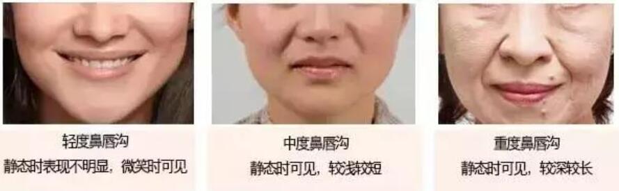 鼻唇溝分為輕度、中度、重度和極度重度