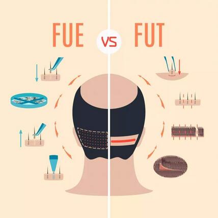 FUE植發(fā)和fut植發(fā)的區(qū)別