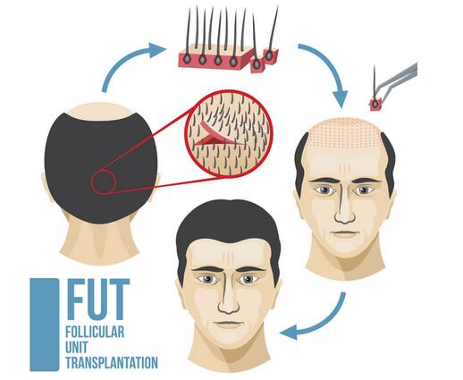 FUT植發(fā)過程圖