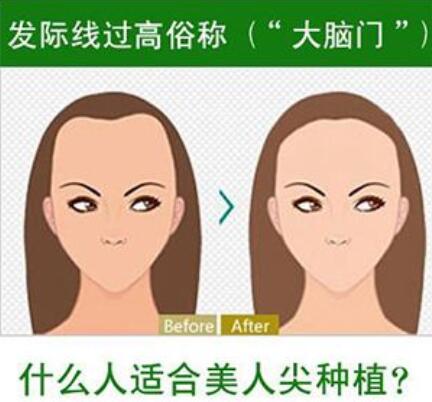 發(fā)際線植發(fā)