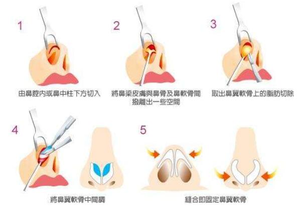 鼻翼縮小的方法