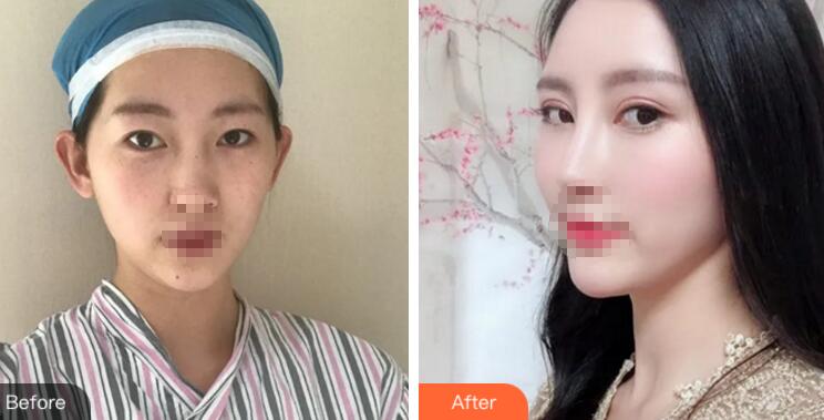 北京協(xié)和醫(yī)院整形外科怎么樣 案例